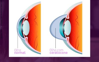 Ceratocone