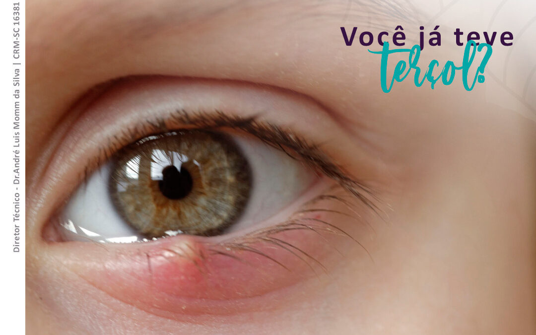 Você já teve TERÇOL?