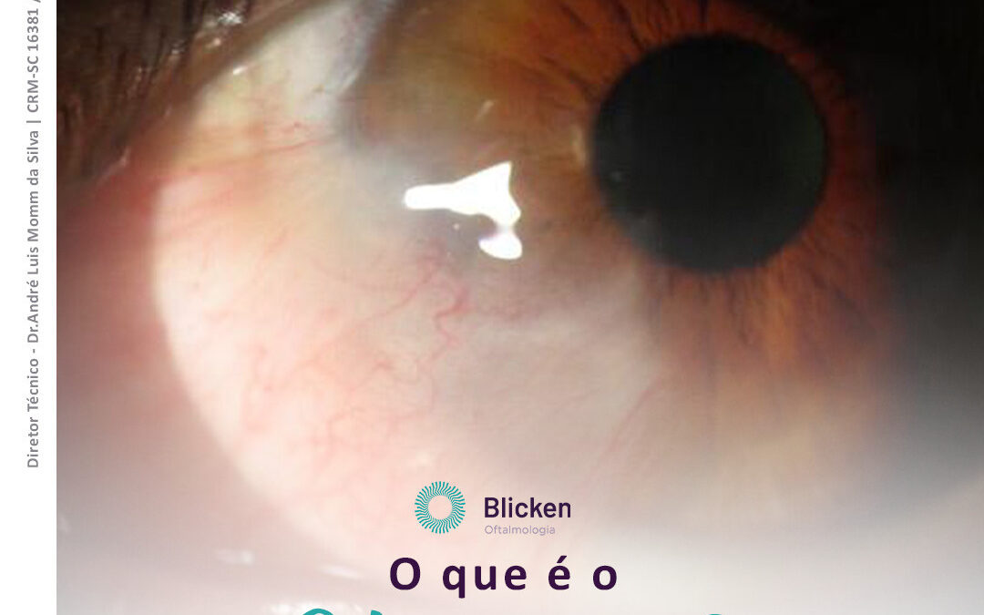 O que é o Pterígio?⠀